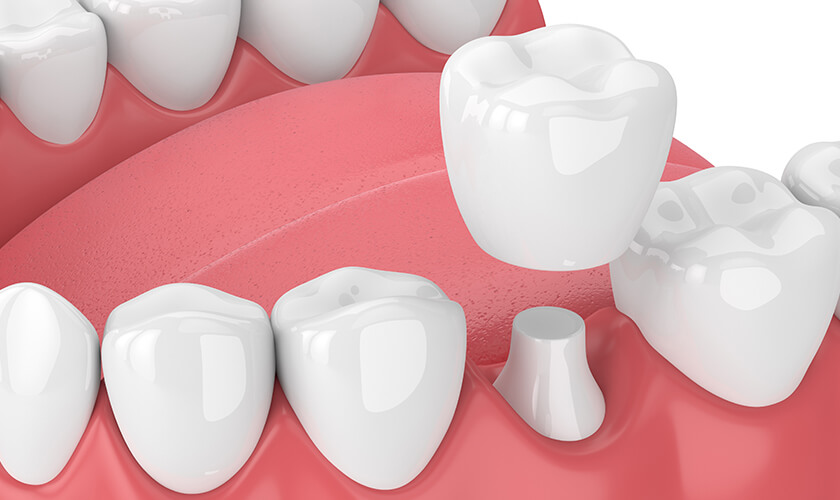 illustration of a dental crown