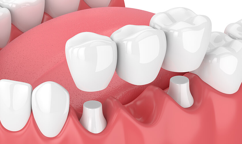 illustration of a dental bridge